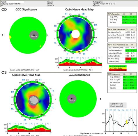 oct-glaucoma - INTEVISA