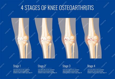 Premium Vector | Knee joint osteoarthritis stages infographics