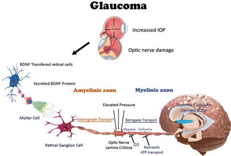 Increased intraocular pressure leads to damage to the optic nerve head ...