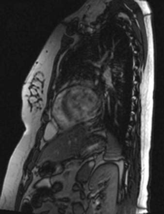 Pericardial cyst | Radiology Reference Article | Radiopaedia.org