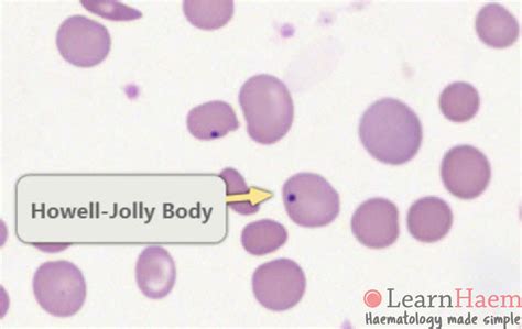 Haemoglobin SC Disease - LearnHaem | Haematology Made Simple