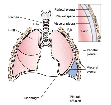 Pleural Effusion - Pleural Conditions