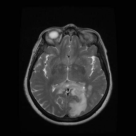 Lesions of the corpus callosum (differential) | Radiology Reference Article | Radiopaedia.org