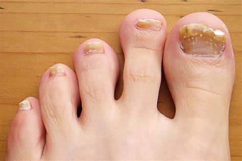 Thick Toenails - Symptoms, Diagnosis and Treatment - Da Vinci Foot and Ankle