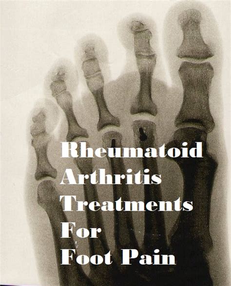 Rheumatoid Arthritis Treatment For Foot Pain