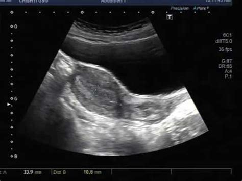 Uterine Polyp Ultrasound