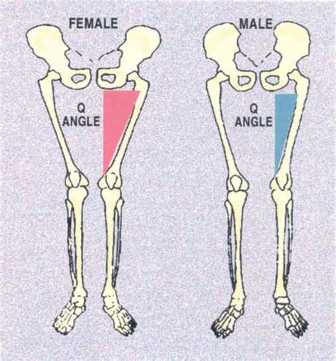 Knee Valgus (Valgus Collapse), Glute Medius Strengthening, Band Hip ...