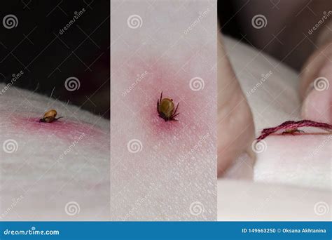 Tick with Its Head Sticking in Human Skin Stock Photo - Image of ...