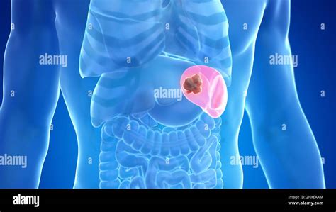 Spleen cancer, illustration Stock Photo - Alamy