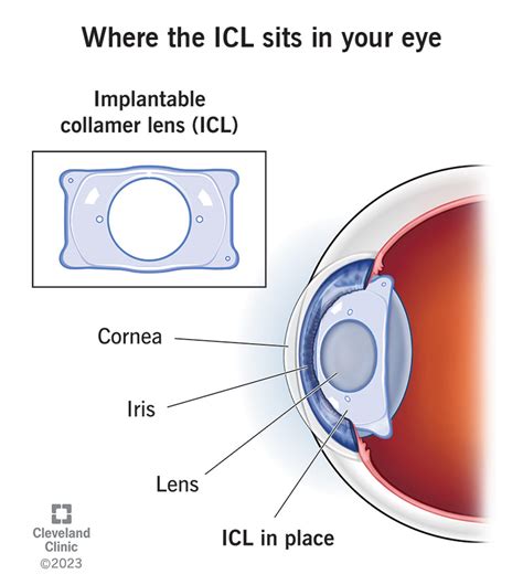 Implantable Collamer Lens (ICL) Surgery