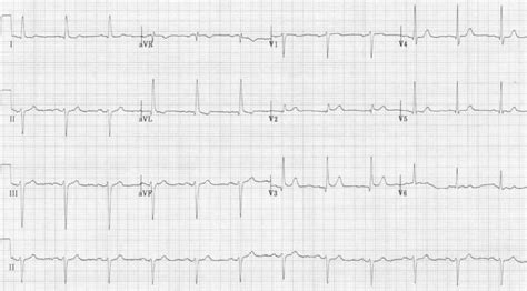 Left Anterior Fascicular Block (LAFB) • LITFL • ECG Library Diagnosis