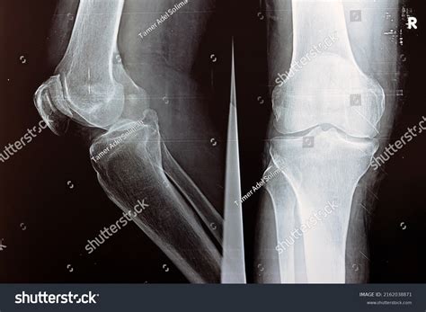 1,709 Lateral Knee Images, Stock Photos & Vectors | Shutterstock