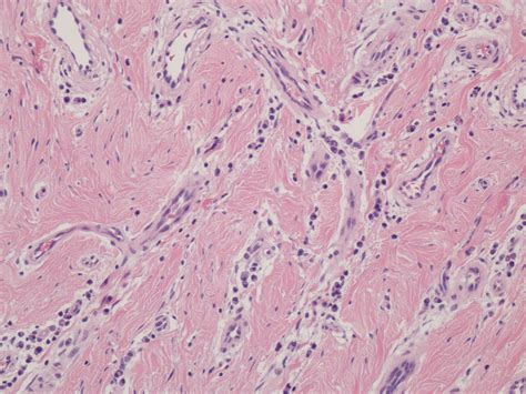 Epulis Fissuratum Histology