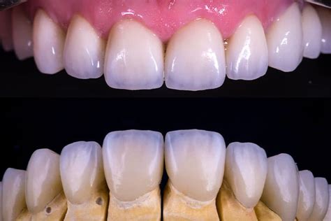 Zirconia Fixed Bridge | East Lansing, MI | Ann Arbor, MI