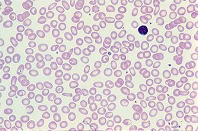 Thalassemia laboratory findings - wikidoc