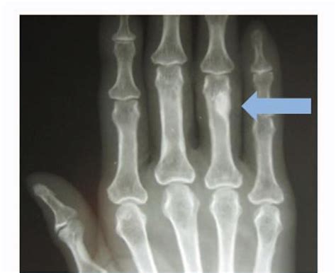 Osteitis Fibrosa Cystica X Ray