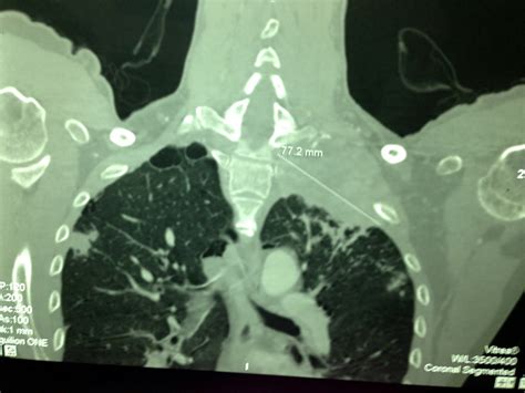 VIETNAMESE MEDIC ULTRASOUND: CASE 224: LEFT SUPRACLAVICULAR MASS, Dr PHAN THANH HẢI, MEDIC ...