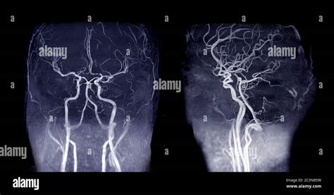 MRA Brain or Magnetic resonance angiography ( MRA ) of cerebral artery and common carotid artery ...