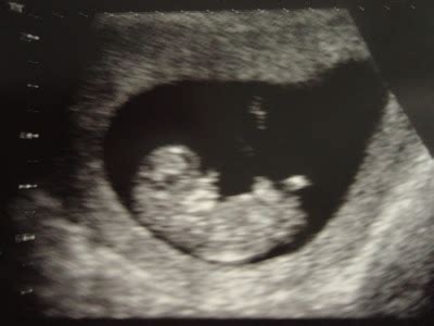 My Baby Journey: Ten (10) Week Ultrasound