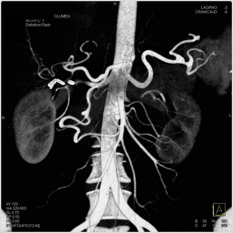 Stenosis Celiac Artery Origin with Flow Through Gastroduodenal Artery ...