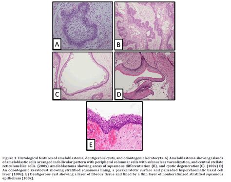 Plexiform Ameloblastoma Histology