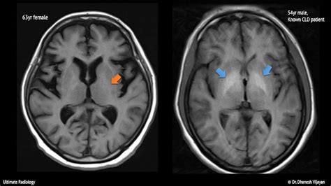 Ultimate Radiology : Bilateral basal ganglia T1 hyperintensity