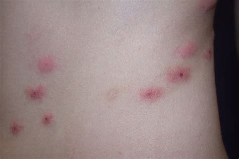 What Are Flea Bites?