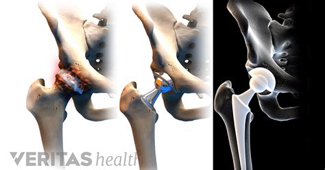 Advantages and Disadvantages of Anterior Hip Replacement