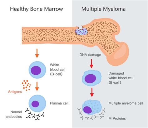 Multiple Myeloma: Signs and symptoms, Causes, Stages, Types, Diagnosis ...