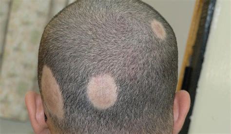 Alopecia areata