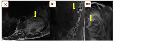 Cystic Mediastinal Schwannoma Presenting as Pleural Effusion