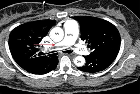 CT of the chest showing saddle emboli (white arrows) in main pulmonary ...