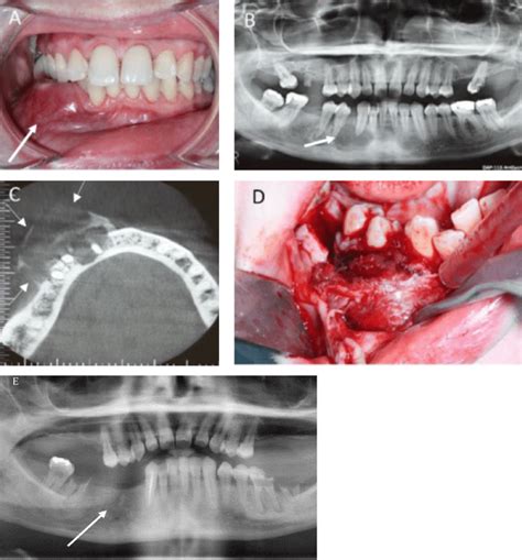 (A) Intraoral view showing a lower right vestibular swelling. (B)... | Download Scientific Diagram