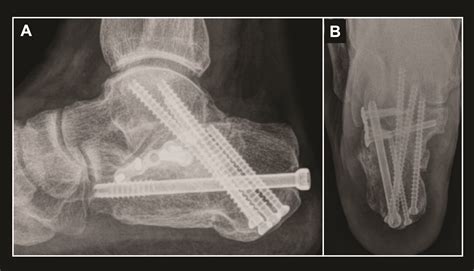 Emerging Insights On Arthroscopic Subtalar Fusion