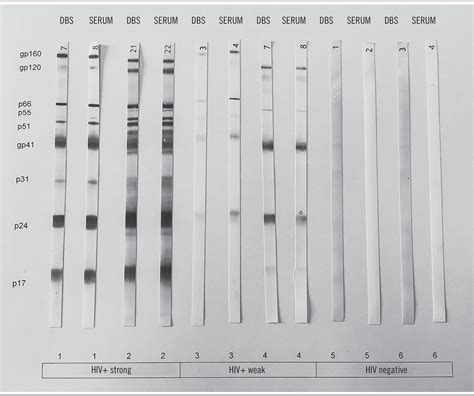 Describe Why the Hiv Western Blot Is a More - Case-has-Dudley