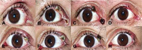 Eyelid margin lesions. Right eye. (A) Umbilicated papules in the middle ...