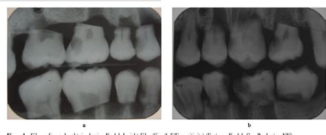 Radiography, Bitewing | Semantic Scholar