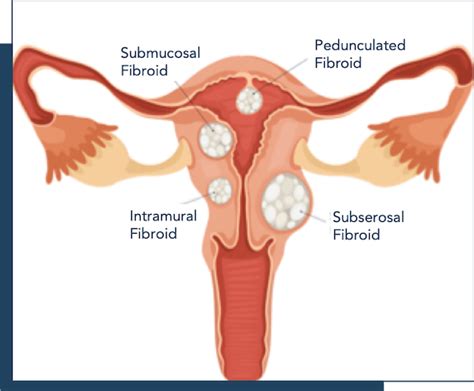 Fibroid Types, Sizes, Location, & FIGO Classifications