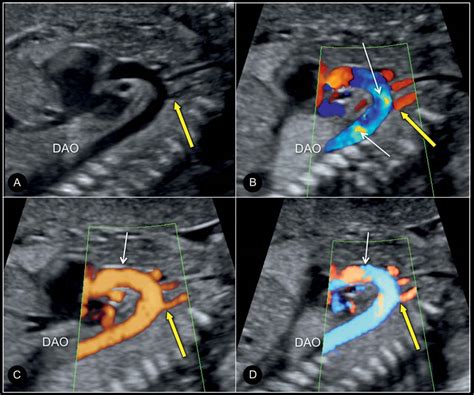 Color Doppler in Fetal Echocardiography | Obgyn Key