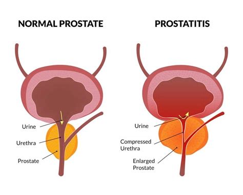 Enlarged Prostate Symptoms, Causes, and Treatment