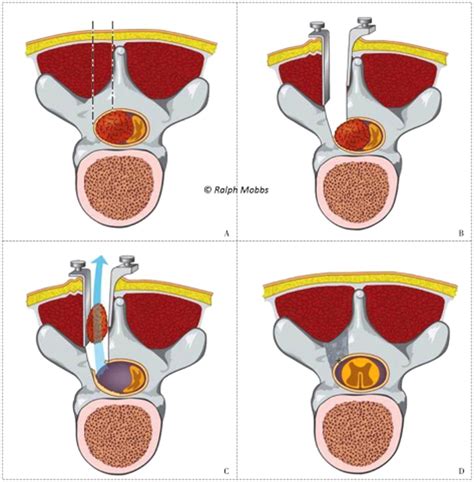 Unilateral Hemilaminectomy for Intradural Lesions - Mobbs - 2015 ...