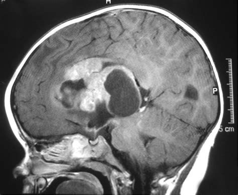 Atypical teratoid rhabdoid tumor - Alchetron, the free social encyclopedia