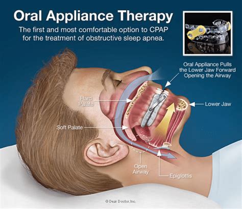 Sleep Apnea Treatment in Hilliard, OH | Fishinger Dental