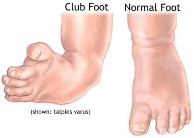 Clubfoot Causes, Symptoms, Diagnosis and Treatment - Natural Health News