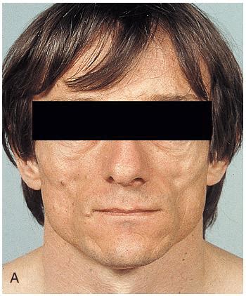 Partial lipodystrophy; note the absence of subcutaneous fat from the face. | Download Scientific ...