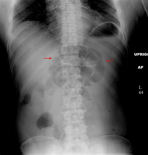 Interpreting An Abdominal X-Ray (KUB) - Stepwards