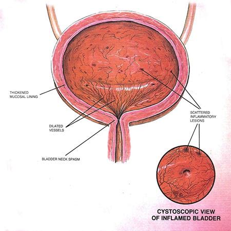 Interstitial Cystitis Treatment Specialist NYC | Midtown & UES