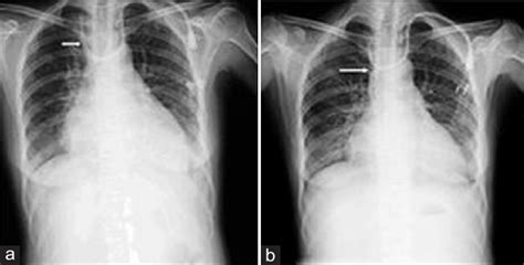 The misplacement of a left internal jugular vein catheter. (a) The ...