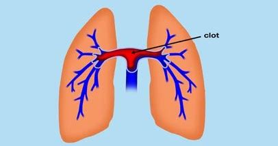 What is Saddle Pulmonary Embolism - Definition, Symptoms, Causes, Treatment - Health Care Tips ...