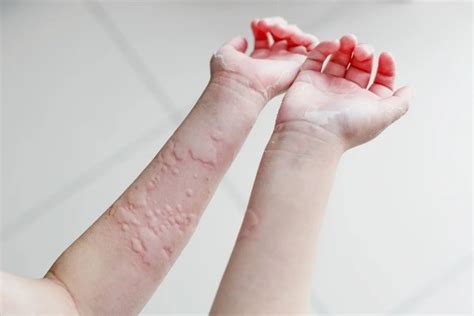 Urticaria: qué es, tipos, síntomas y causas - Tua Saúde